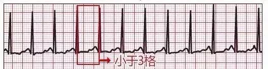 10种异常心电图秒懂,第3张