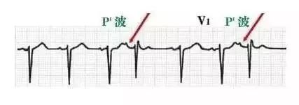 10种异常心电图秒懂,第15张