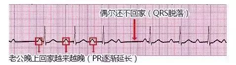 10种异常心电图秒懂,第9张