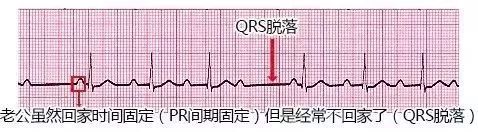 10种异常心电图秒懂,第10张