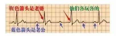 10种异常心电图秒懂,第11张