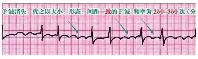 10种异常心电图秒懂,第18张