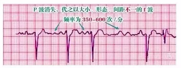 10种异常心电图秒懂,第20张
