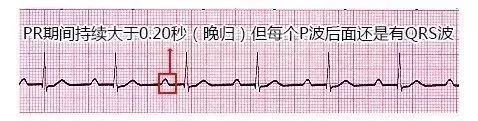 10种异常心电图秒懂,第8张