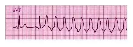 10种异常心电图秒懂,第22张