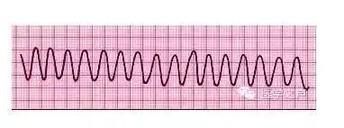 10种异常心电图秒懂,第23张