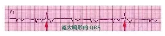 10种异常心电图秒懂,第16张