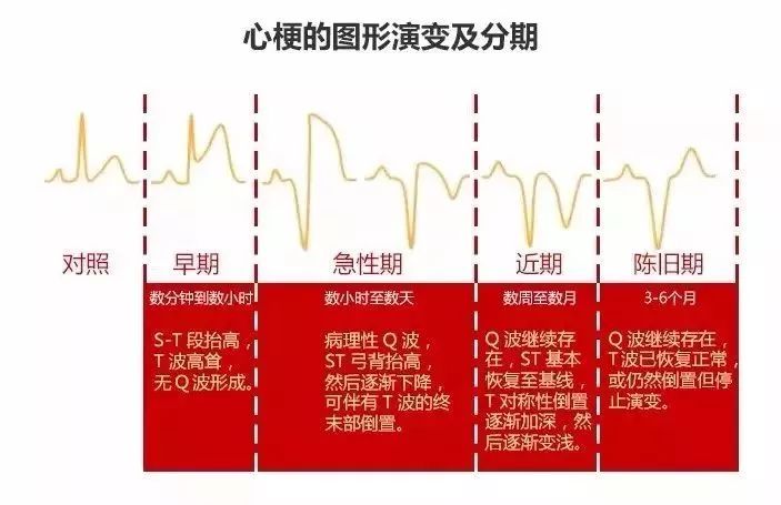 10种异常心电图秒懂,第27张