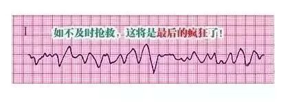 10种异常心电图秒懂,第25张